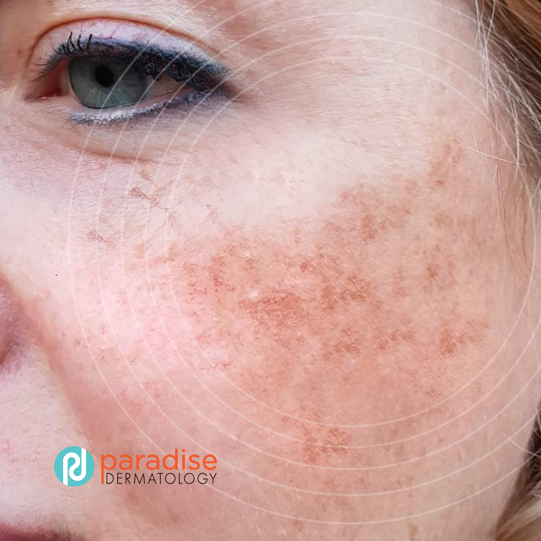 Melasma Unmasked Dermatology Blog